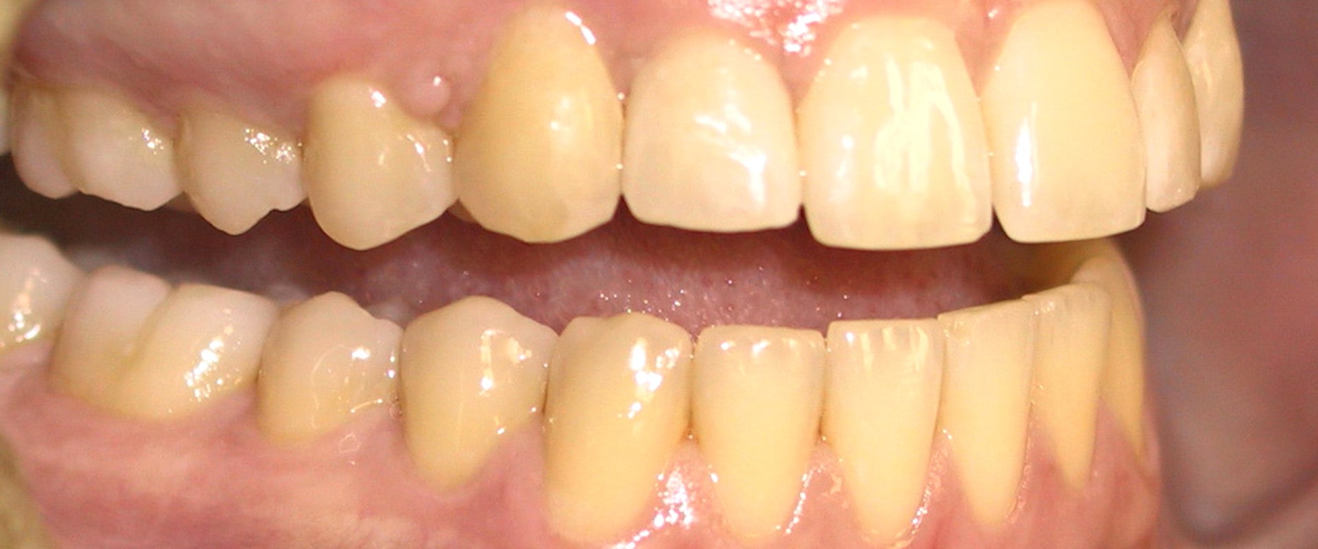 Can Veneers Turn Yellow? Expert Advice on How to Keep Your Teeth White