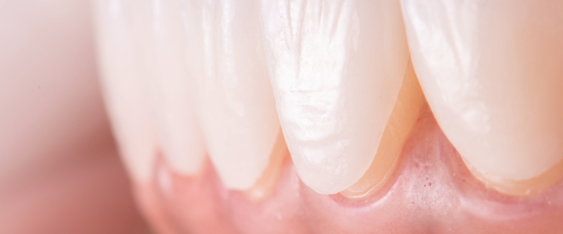 Do Veneers Get Discolored? How to Keep Your Veneers Looking White