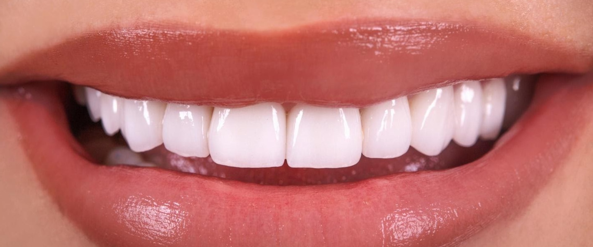 Are Dental Veneers Worth It? A Comprehensive Guide
