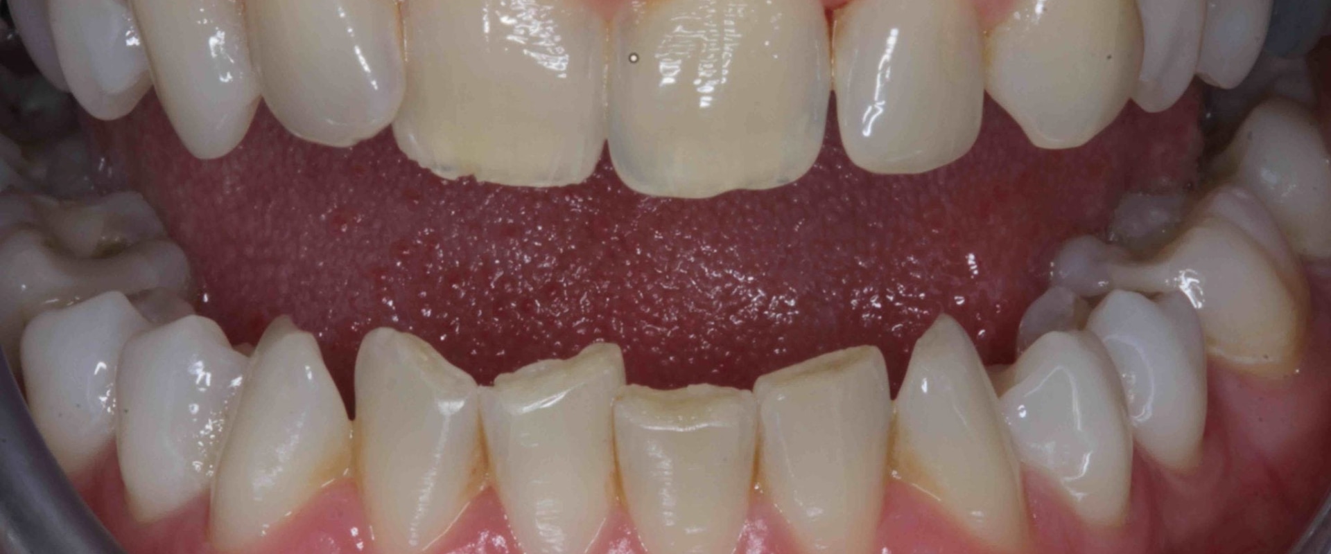 How Many Veneers Are Needed for a Full Set of Teeth?