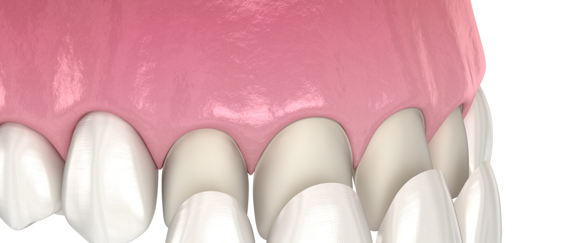 How Long Can Porcelain and Composite Veneers Last?