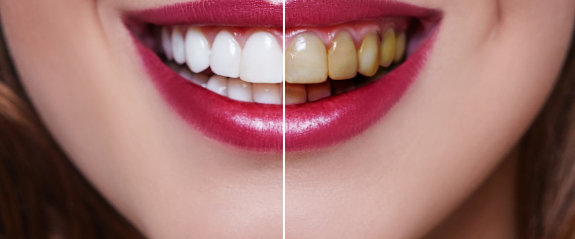 Do veneers turn yellow?