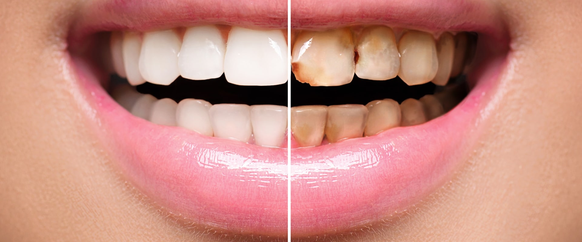 What Happens to Porcelain Veneers After 20 Years?
