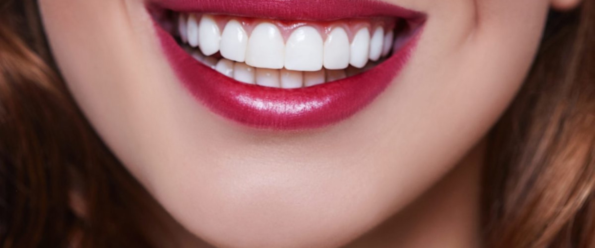 How Many Veneers Do You Need for a Perfect Smile?