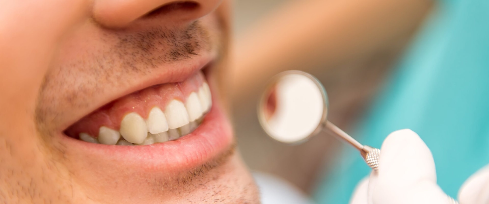 Do Veneers Need to be Replaced Every 10 Years?