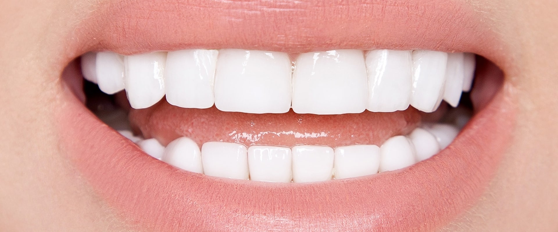 How Many Veneers Do I Need for a Perfect Smile?