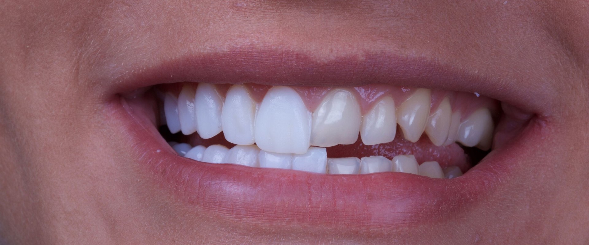 How Long Do Permanent Veneers Last?