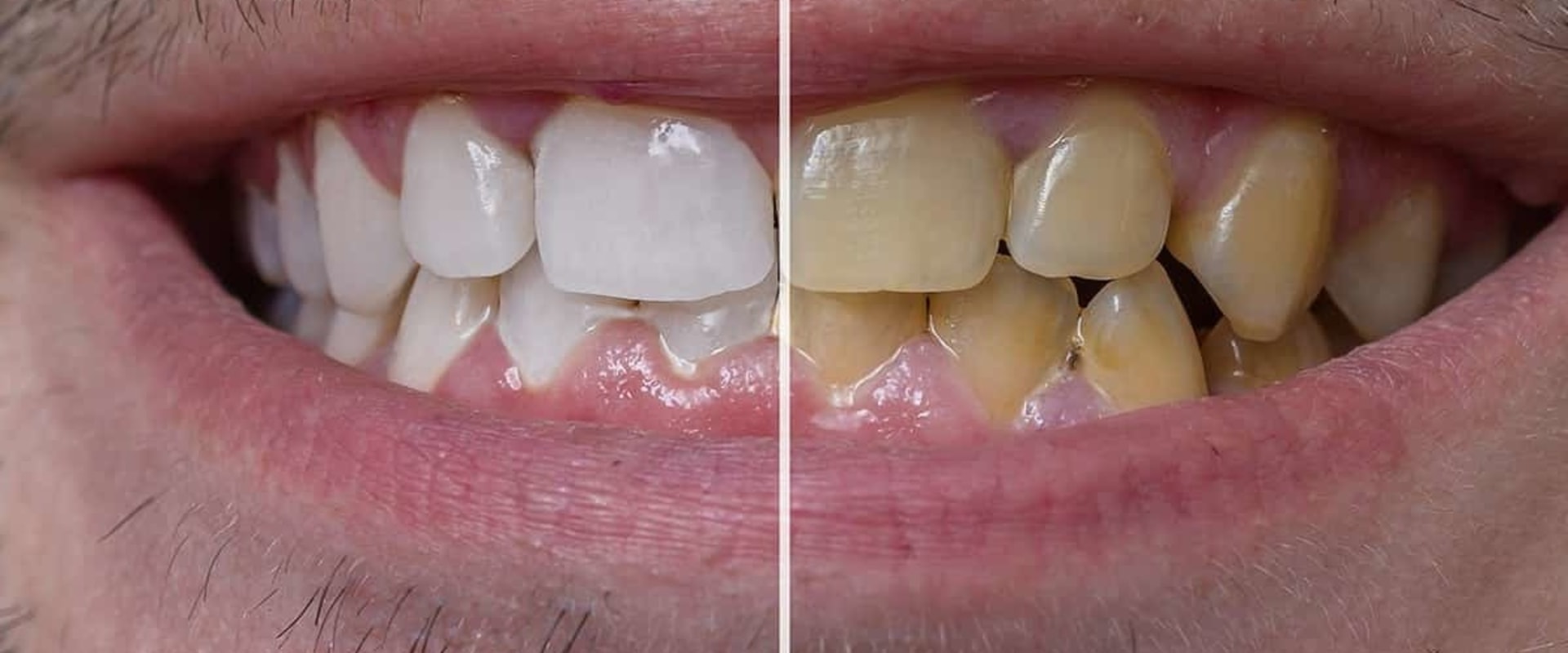 How do you whiten yellow veneers?