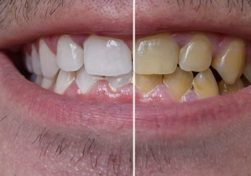 How to get rid of yellow stains on veneers
