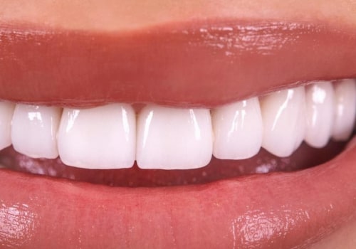 Are dental veneers worth it? - A comprehensive guide
