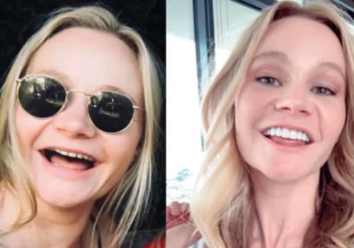 Can You Get Lifelong Veneers?