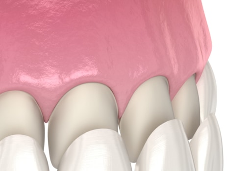 How long can porcelain and composite veneers last?