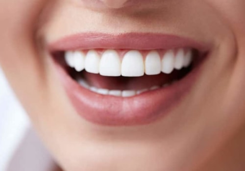 Are Veneers Worth It? A Comprehensive Guide