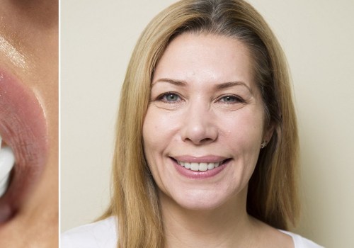 What does getting veneers feel like? An expert's perspective