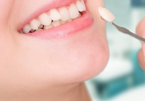 Can porcelain veneers last a lifetime?