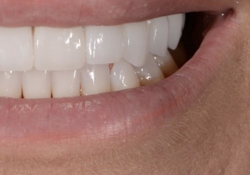 Can veneers cause health issues? A comprehensive guide